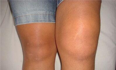 Die Ursachen für Arthrose des Kniegelenks